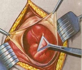 Apendicetomía abierta