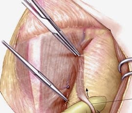 Resección de ganglios
